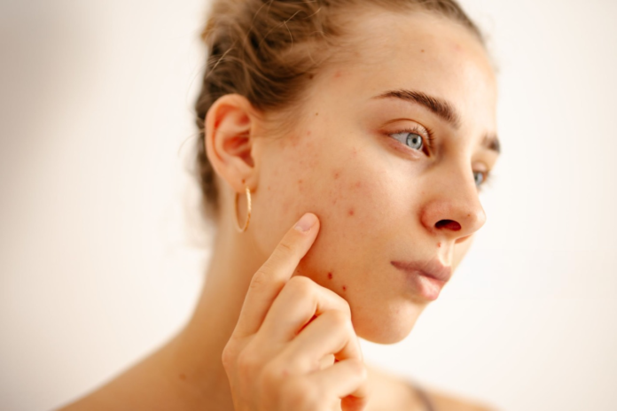 How Paula’s Choice Helps with Acne-Prone Skin