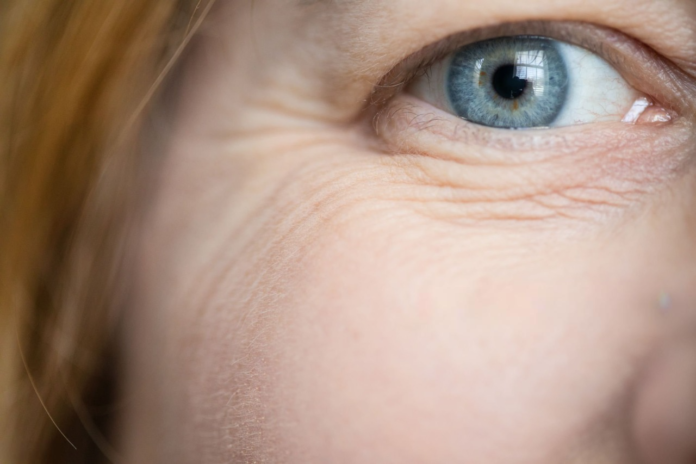 How to Prevent Wrinkles Around the Eyes