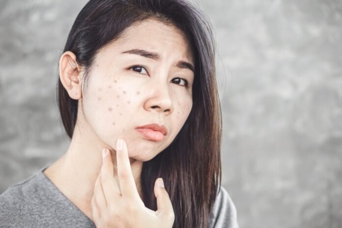 How to Fade Dark Spots and Hyperpigmentation Safely