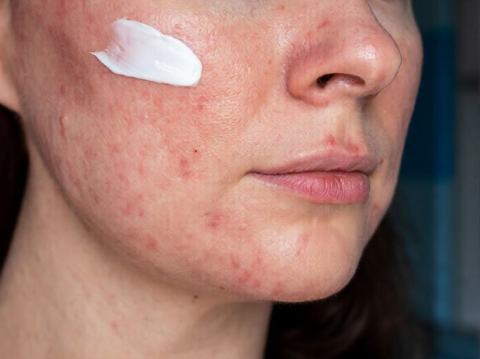 How La Roche-Posay Effaclar Targets Acne Effectively