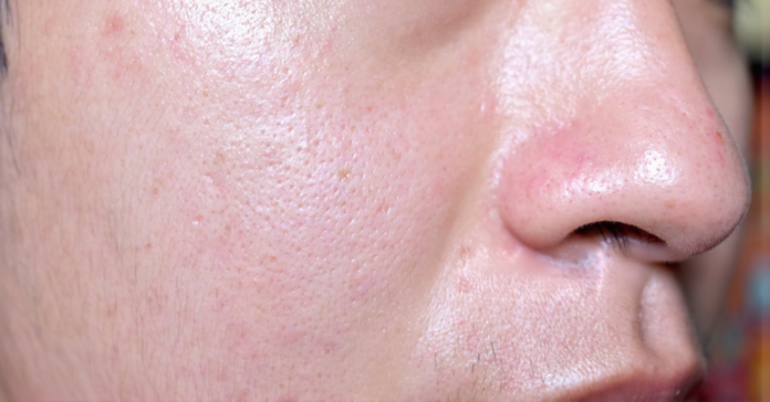 How CeraVe’s Ceramide Complex Repairs the Skin Barrier