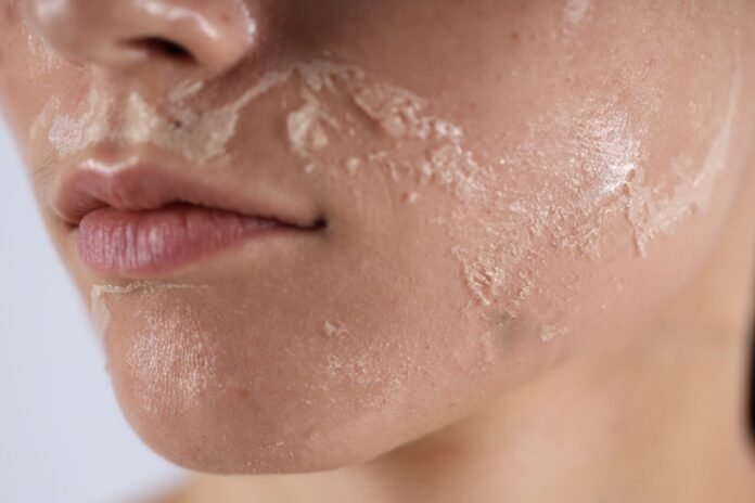 How to prevent over-exfoliation damage